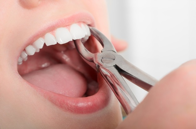 3 Things to Avoid After Tooth Extraction
