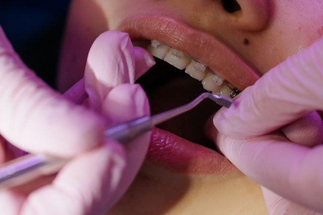 Adult Braces and How to Care for Them Image