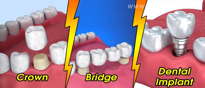 Difference between a Crown, Bridge and Dental Implant