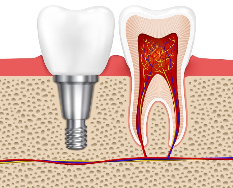 Root Canal Symptoms: How Do You Know If You Need a Root Canal